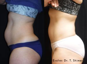 Evolve Body Sculpting Before and After Results